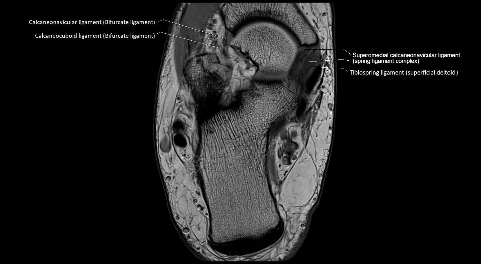 MRI ankle ligaments anatomy axial 3T image 17.webp